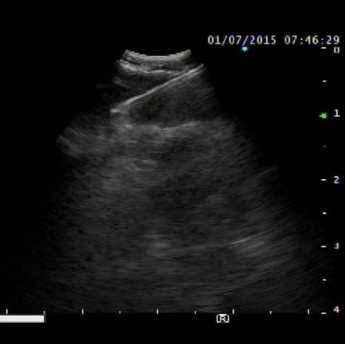 Expect™ Pulmonary EBUS-TBNA Needle - Product View 4